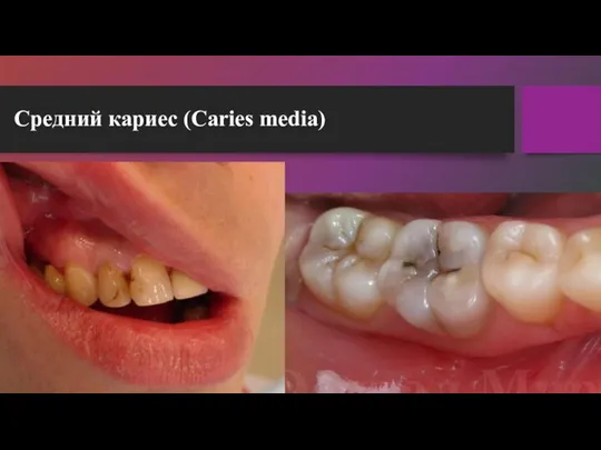 Средний кариес (Caries media)