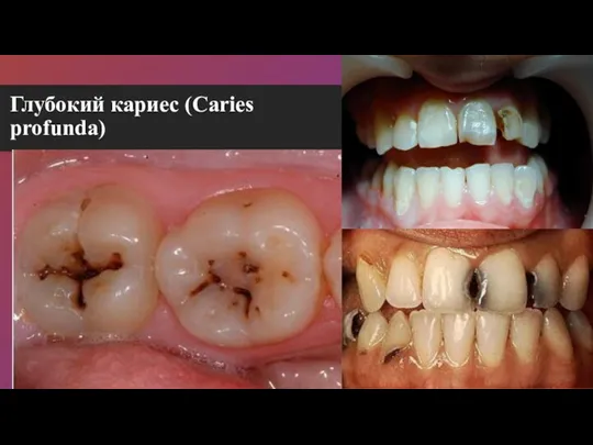 Глубокий кариес (Caries profunda)