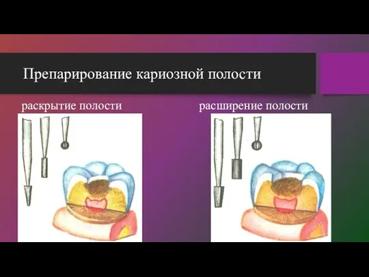 Препарирование кариозной полости раскрытие полости расширение полости