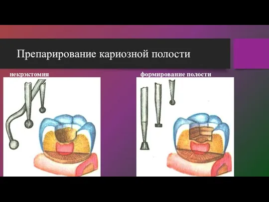 Препарирование кариозной полости некрэктомия формирование полости