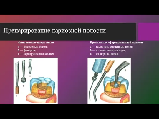 Препарирование кариозной полости Финирование краев эмали а — фиссурным бором;