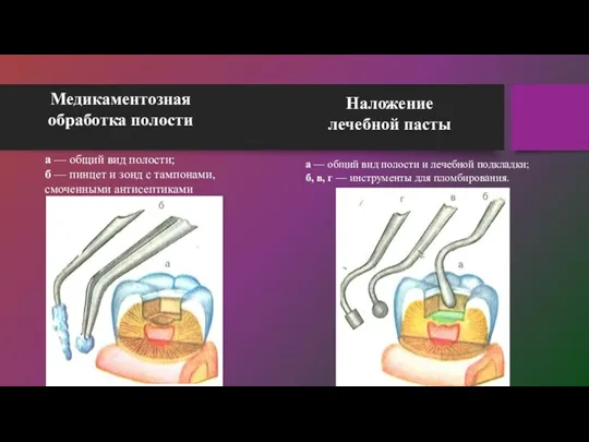 Медикаментозная обработка полости Наложение лечебной пасты а — общий вид