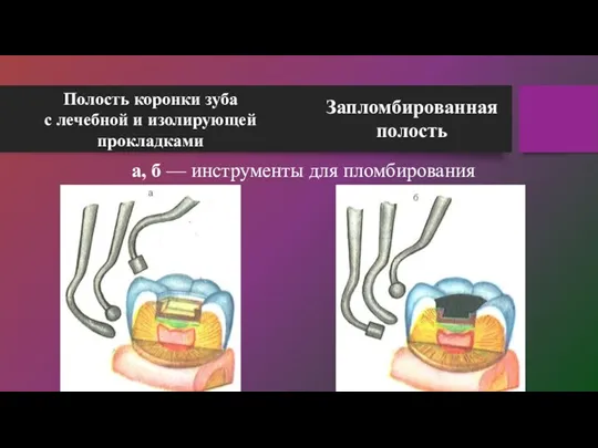 Полость коронки зуба с лечебной и изолирующей прокладками а, б — инструменты для пломбирования Запломбированная полость