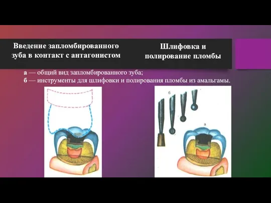 Введение запломбированного зуба в контакт с антагонистом Шлифовка и полирование