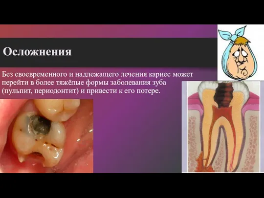 Осложнения Без своевременного и надлежащего лечения кариес может перейти в