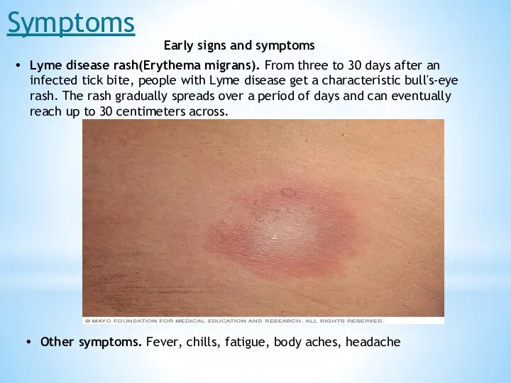 Symptoms Early signs and symptoms Lyme disease rash(Erythema migrans). From