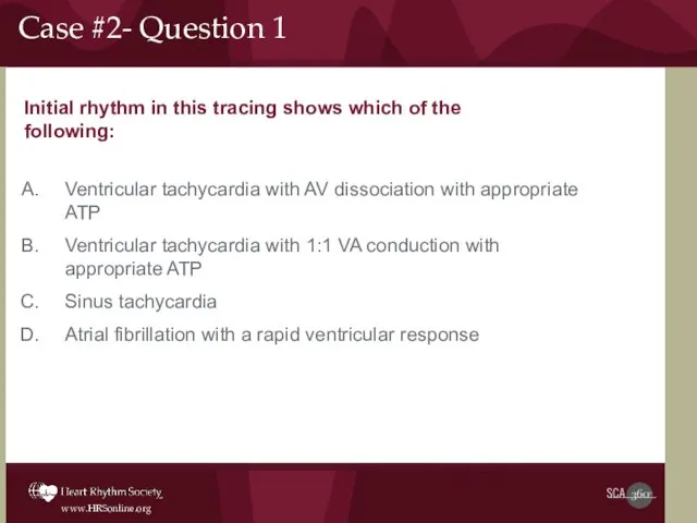 Initial rhythm in this tracing shows which of the following: