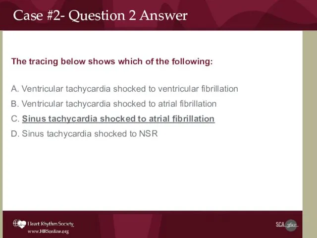 The tracing below shows which of the following: A. Ventricular