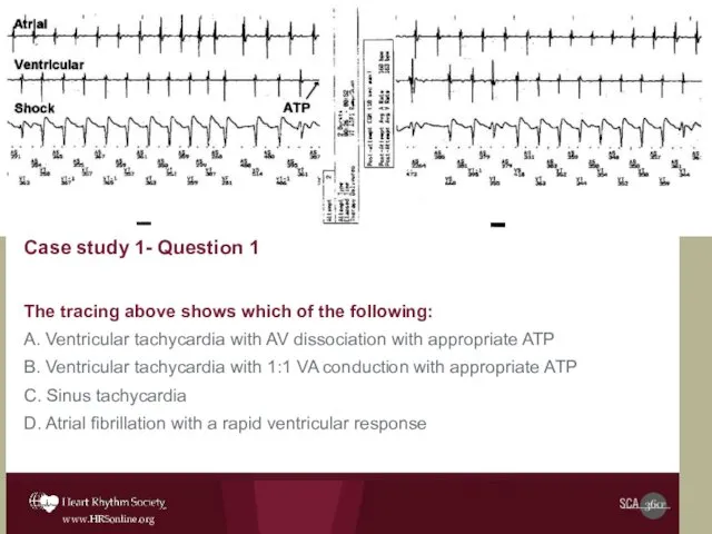 Case study 1- Question 1 The tracing above shows which