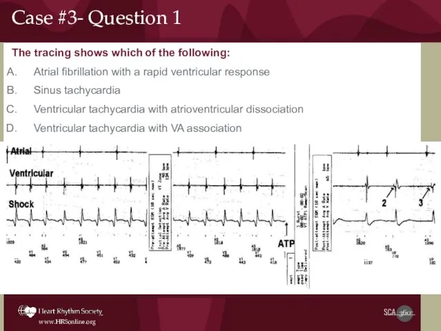 The tracing shows which of the following: Atrial fibrillation with