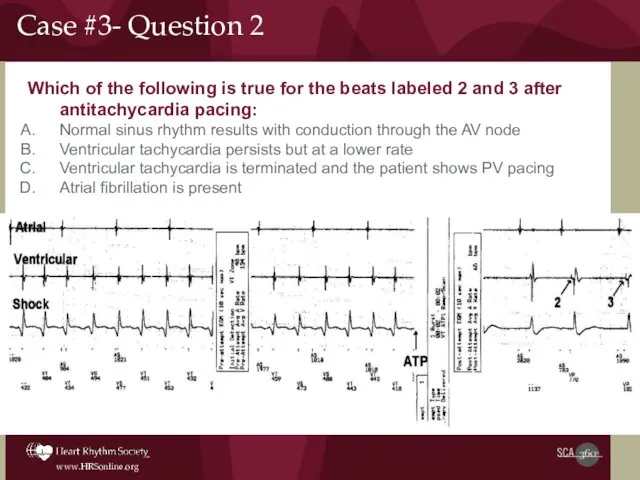 Which of the following is true for the beats labeled