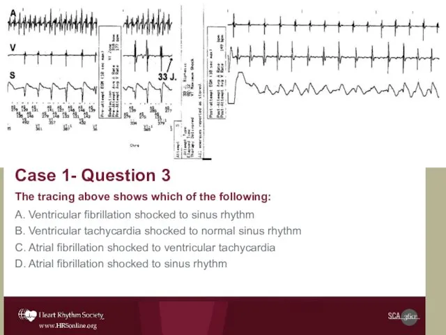 Case 1- Question 3 The tracing above shows which of