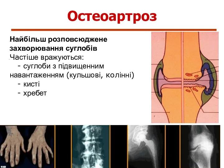 Остеоартроз Найбільш розповсюджене захворювання суглобів Частіше вражуються: - суглоби з підвищенним навантаженням (кульшові,
