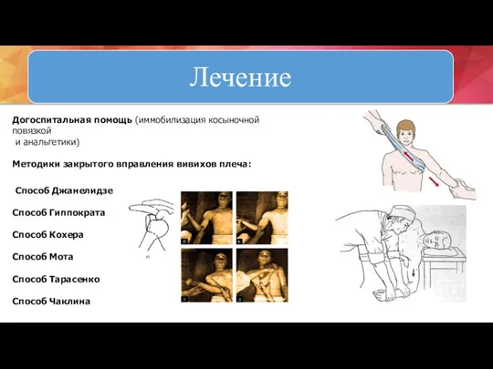 Догоспитальная помощь (иммобилизация косыночной повязкой и анальгетики) Методики закрытого вправления