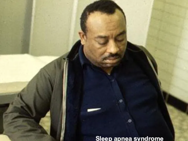 Sleep apnea syndrome