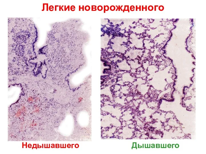 Легкие новорожденного Недышавшего Дышавшего