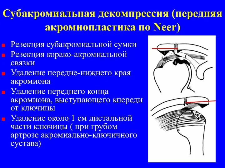 Субакромиальная декомпрессия (передняя акромиопластика по Neer) Резекция субакромиальной сумки Резекция