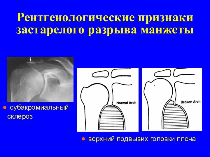 Рентгенологические признаки застарелого разрыва манжеты субакромиальный склероз верхний подвывих головки плеча