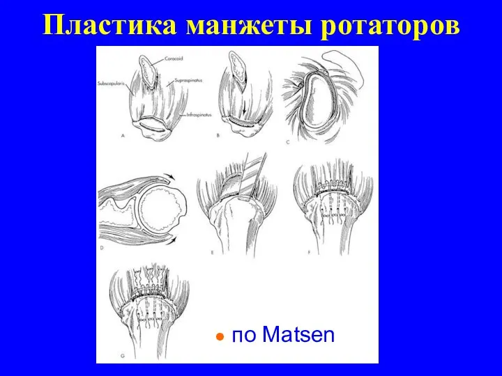 Пластика манжеты ротаторов по Matsen