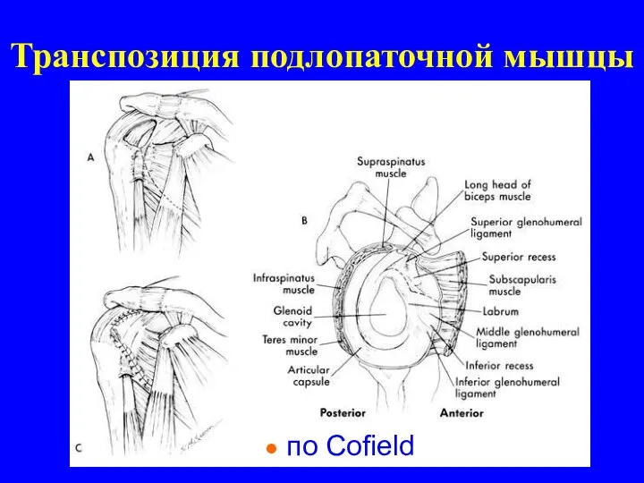 Транспозиция подлопаточной мышцы по Cofield