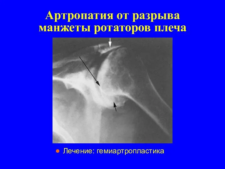 Артропатия от разрыва манжеты ротаторов плеча Лечение: гемиартропластика