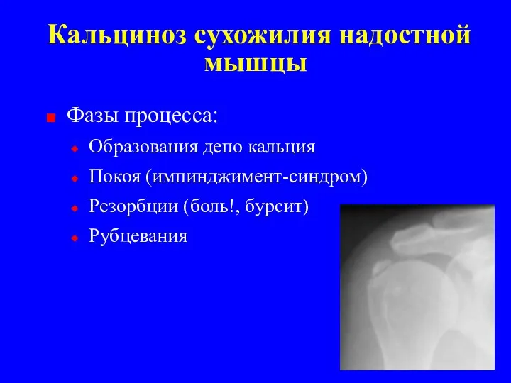 Кальциноз сухожилия надостной мышцы Фазы процесса: Образования депо кальция Покоя (импинджимент-синдром) Резорбции (боль!, бурсит) Рубцевания