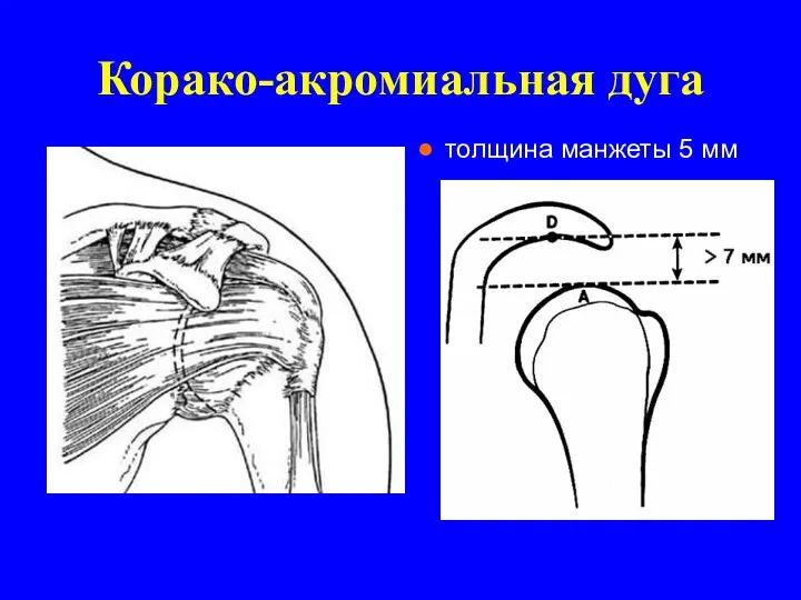 Корако-акромиальная дуга толщина манжеты 5 мм