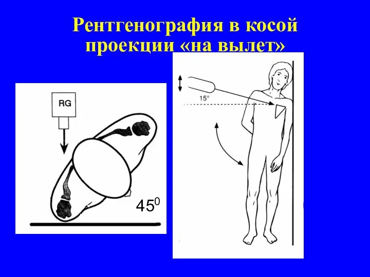 Рентгенография в косой проекции «на вылет» 450