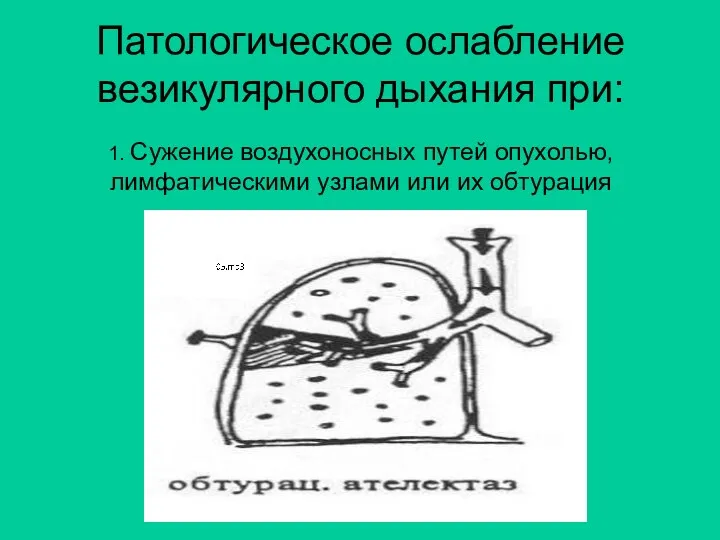 Патологическое ослабление везикулярного дыхания при: 1. Сужение воздухоносных путей опухолью, лимфатическими узлами или их обтурация