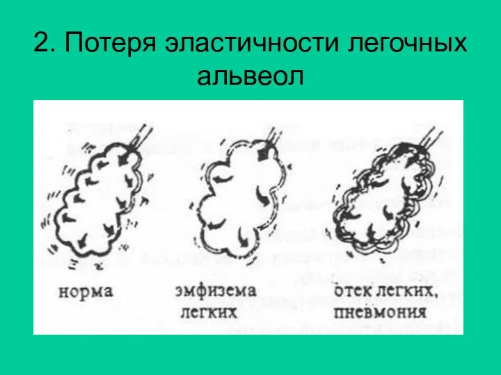 2. Потеря эластичности легочных альвеол