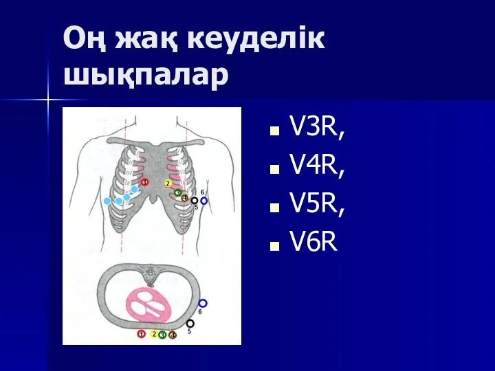 Оң жақ кеуделік шықпалар V3R, V4R, V5R, V6R