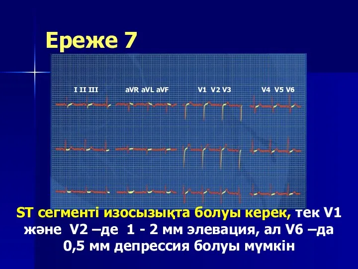 Ереже 7 ST сегменті изосызықта болуы керек, тек V1 және