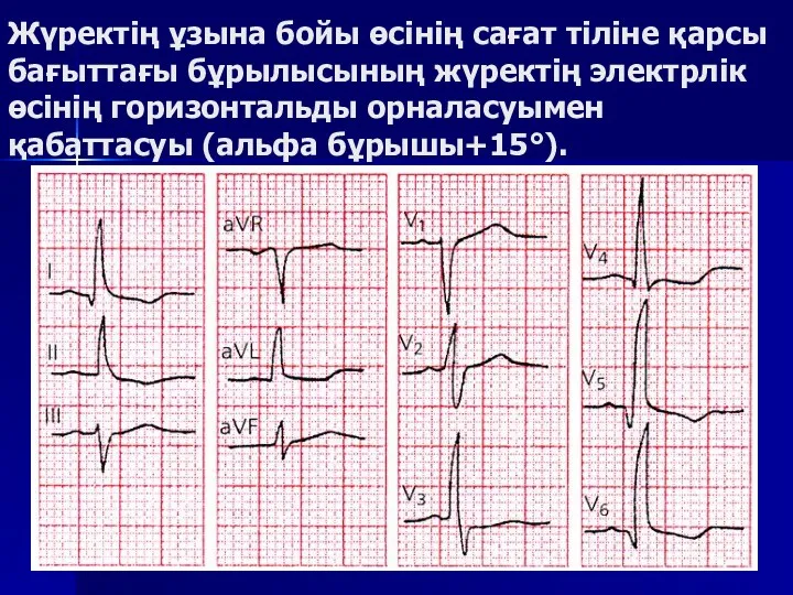 Жүректің ұзына бойы өсінің сағат тіліне қарсы бағыттағы бұрылысының жүректің