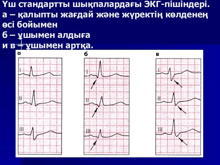 Үш стандартты шықпалардағы ЭКГ-пішіндері. а – қалыпты жағдай және жүректің