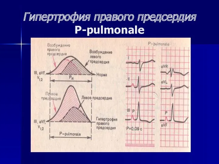 Гипертрофия правого предсердия P-pulmonale