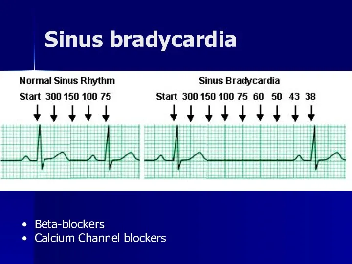 Sinus bradycardia Beta-blockers Calcium Channel blockers