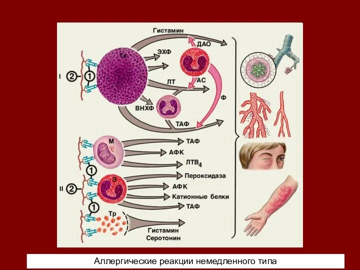 Аллергические реакции немедленного типа