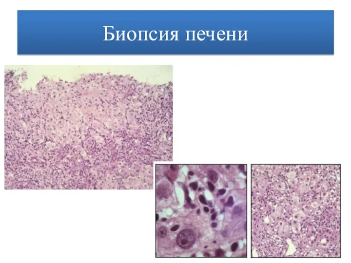 Биопсия печени