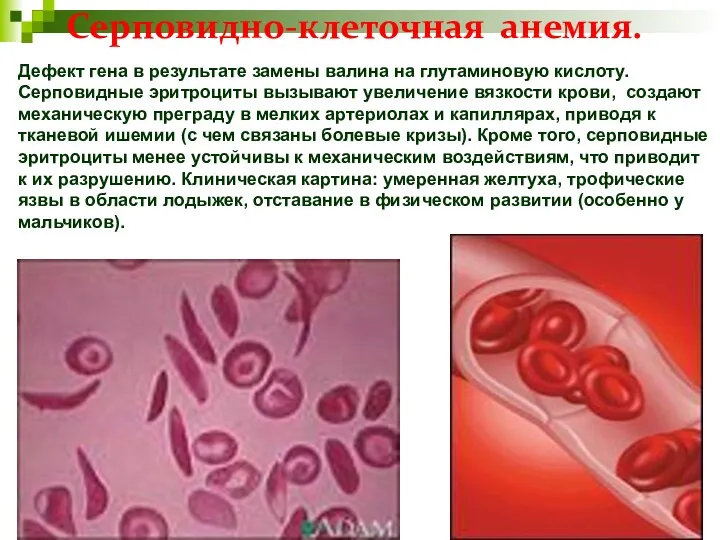 Серповидно-клеточная анемия. Дефект гена в результате замены валина на глутаминовую