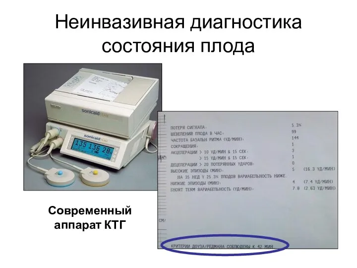 Неинвазивная диагностика состояния плода Современный аппарат КТГ