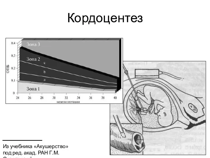 Кордоцентез Из учебника «Акушерство» под ред. акад. РАН Г.М. Савельевой