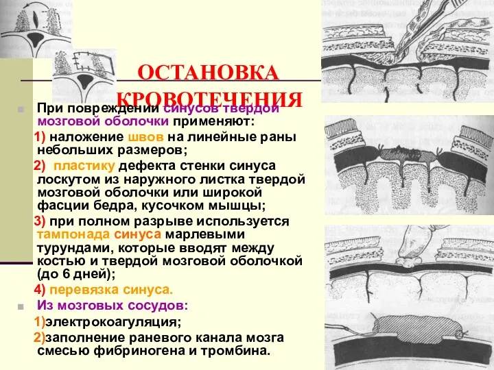 ОСТАНОВКА КРОВОТЕЧЕНИЯ При повреждении синусов твердой мозговой оболочки применяют: 1)