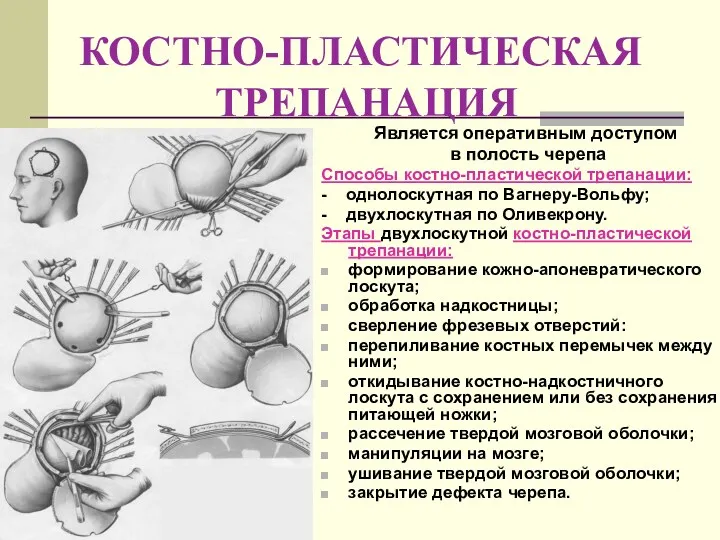 КОСТНО-ПЛАСТИЧЕСКАЯ ТРЕПАНАЦИЯ Является оперативным доступом в полость черепа Способы костно-пластической