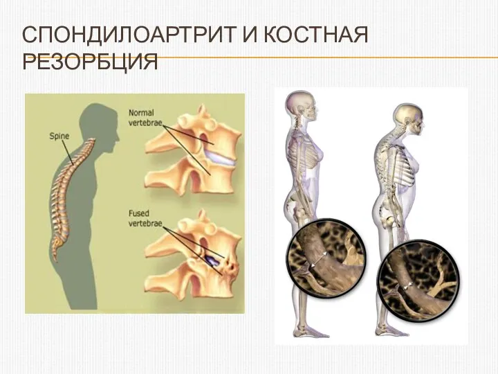 СПОНДИЛОАРТРИТ И КОСТНАЯ РЕЗОРБЦИЯ