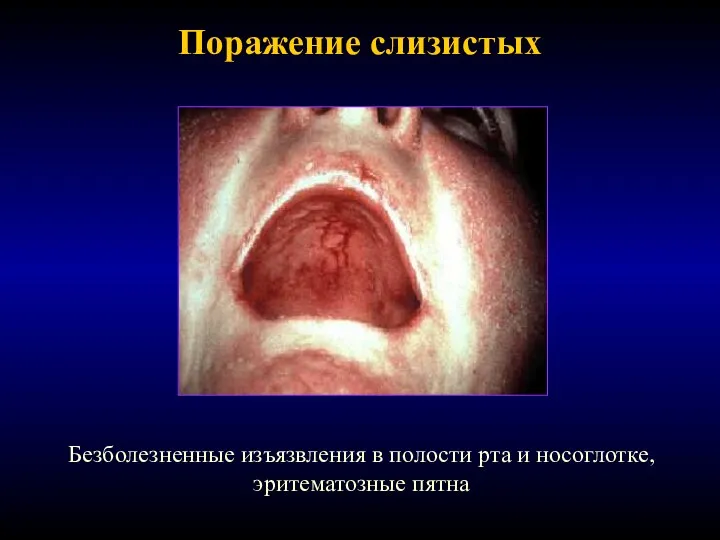Поражение слизистых Безболезненные изъязвления в полости рта и носоглотке, эритематозные пятна