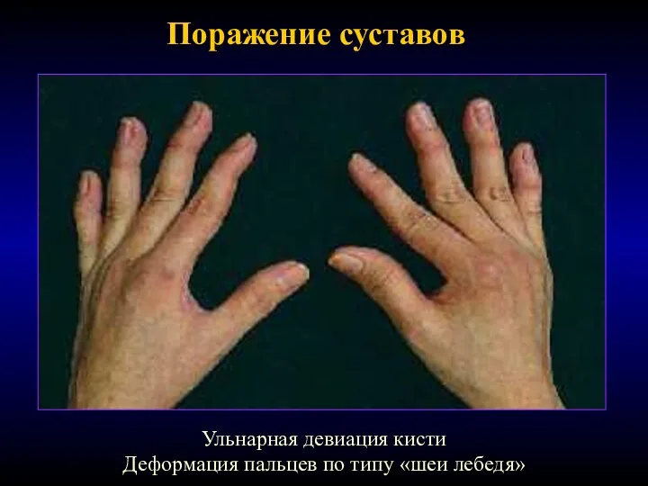 Поражение суставов Ульнарная девиация кисти Деформация пальцев по типу «шеи лебедя»