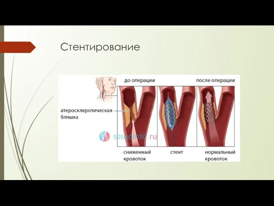 Стентирование