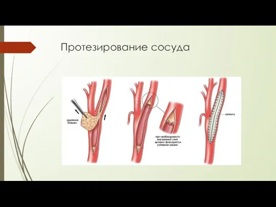 Протезирование сосуда