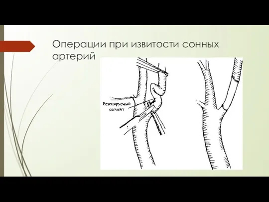 Операции при извитости сонных артерий