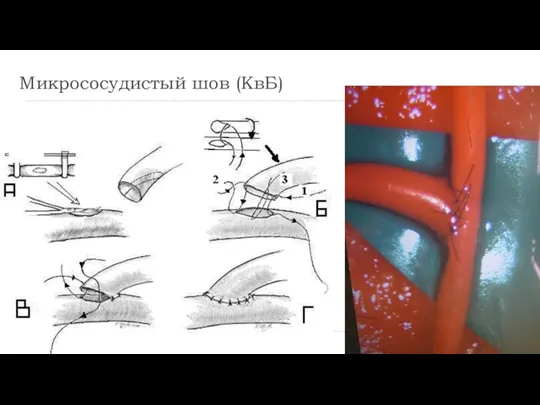 Микрососудистый шов (КвБ)